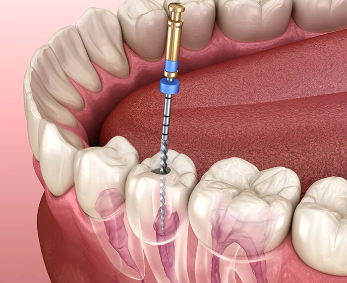 Root Canal Treatment Portland OR - Endodontics