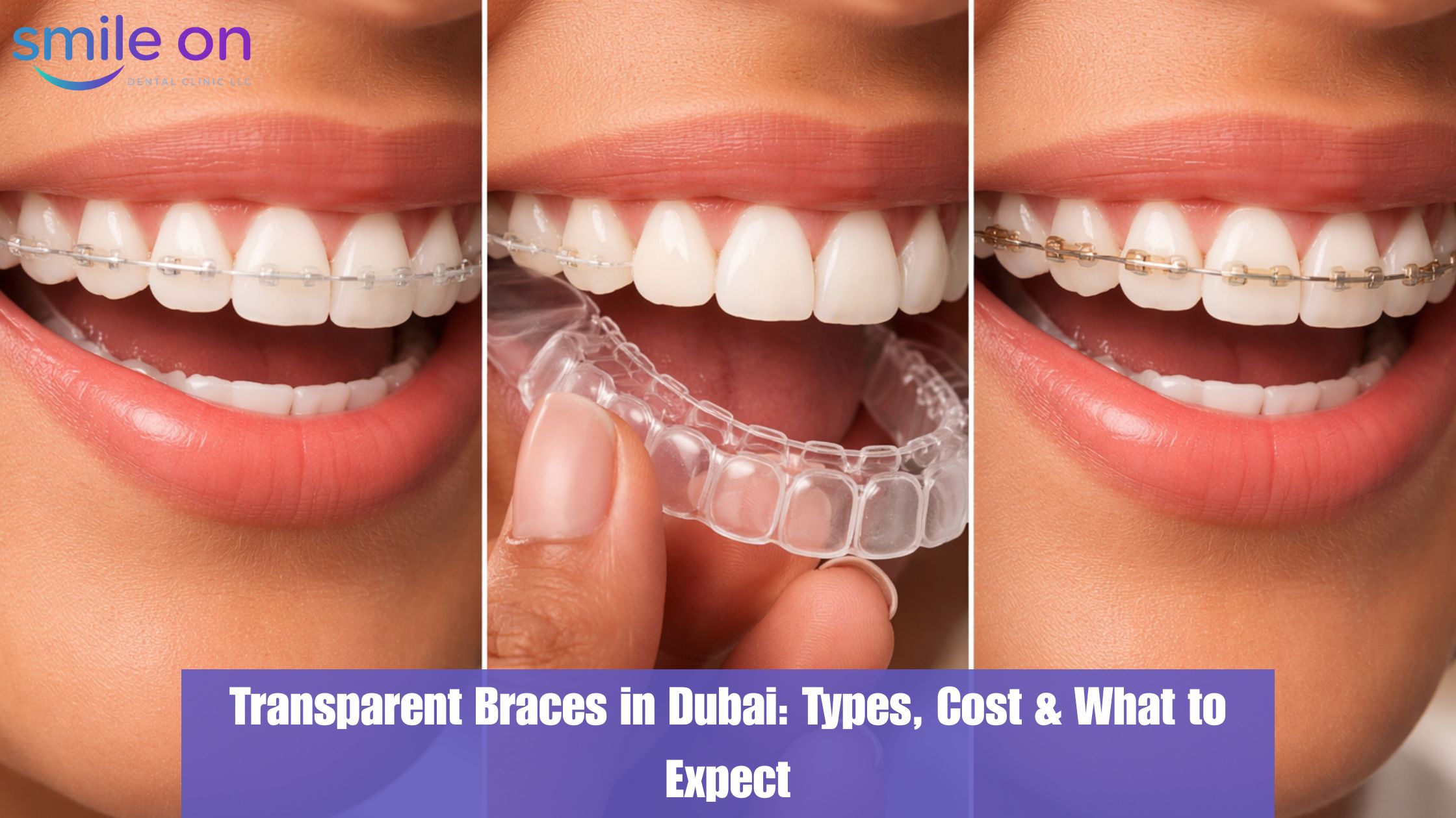 Transparent Braces in Dubai: Types, How They Work, and What to Expect