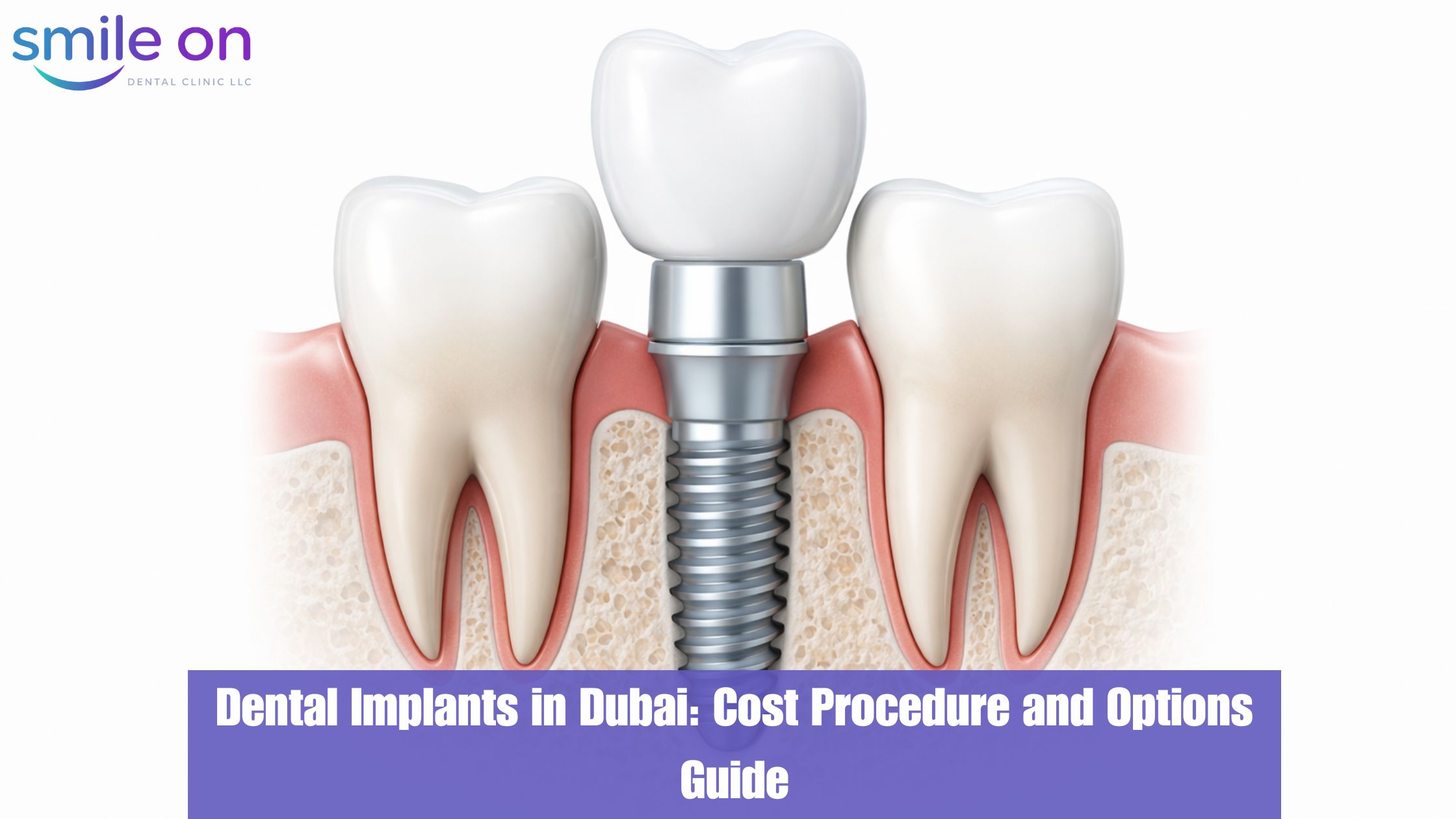 Dental Implants in Dubai: Costs, Procedure & How to Choose the Right Clinic