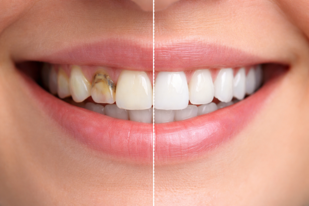Before and after dental crown treatment showing tooth restoration result