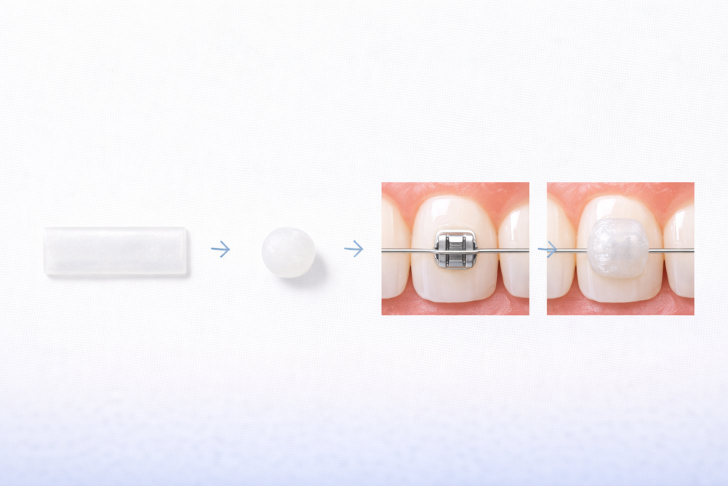 Step-by-step guide to applying orthodontic wax to braces brackets