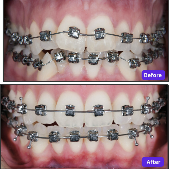 Before and after (Orthodontic)