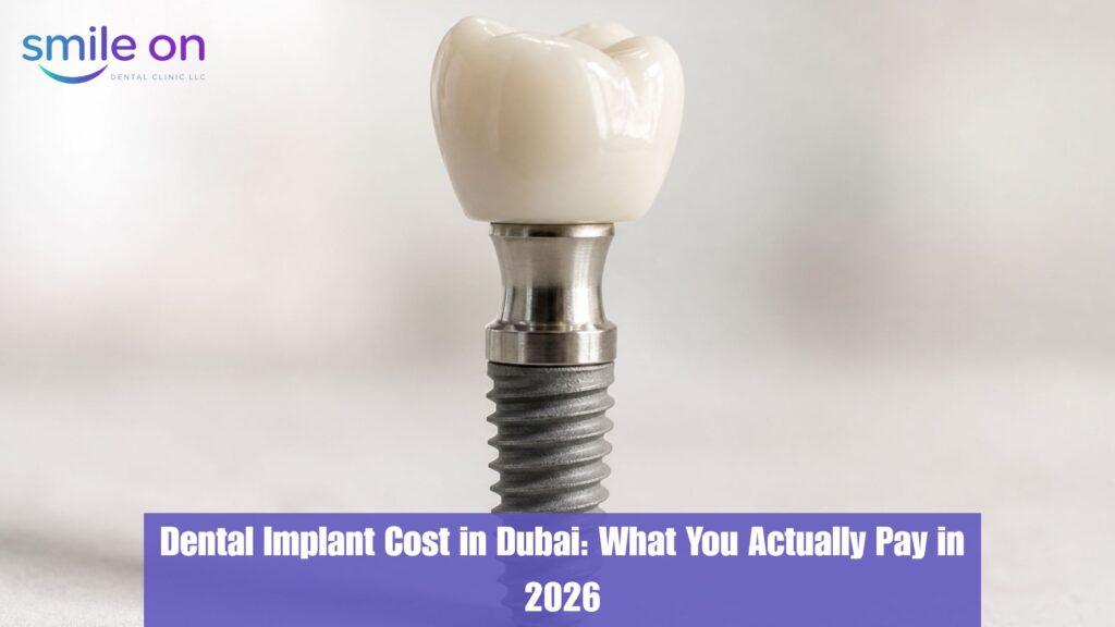 Dental implant components — post, abutment, and crown — used at Smile On Dental Clinic Dubai