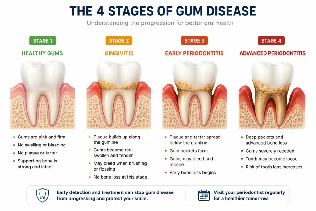 Four stages of gum disease from healthy gums to advanced periodontitis showing bone loss progression