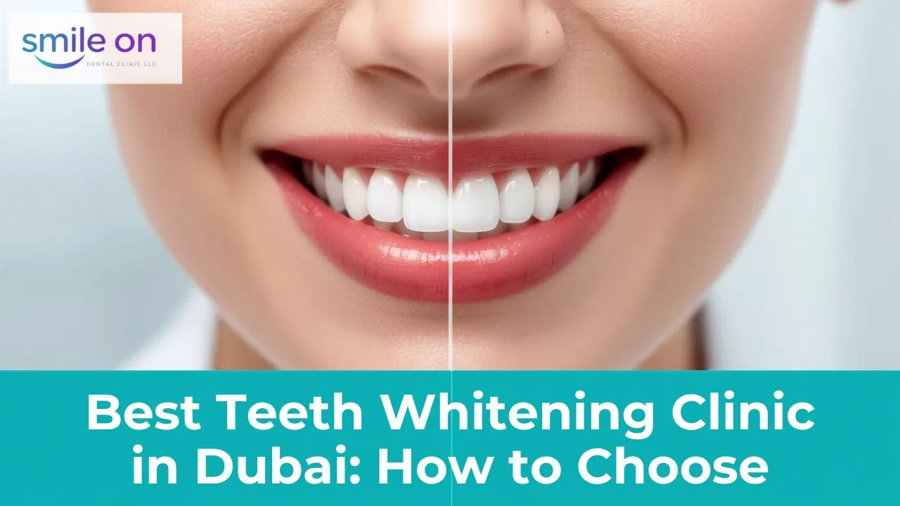Best Teeth Whitening Clinic in Dubai: How to Choose — Smile On Dental Clinic