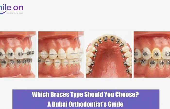 Which Braces Type Should You Choose? A Dubai Orthodontist's Guide