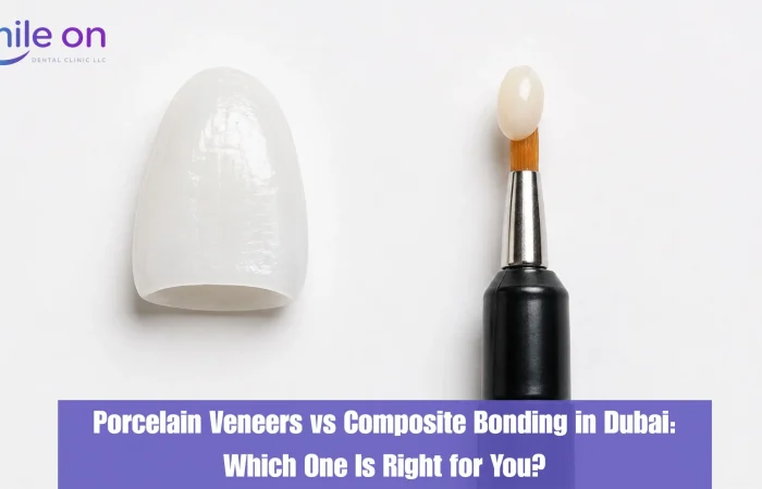Porcelain veneer vs composite bonding — cosmetic dentistry treatment comparison at Smile On Dental Clinic Dubai