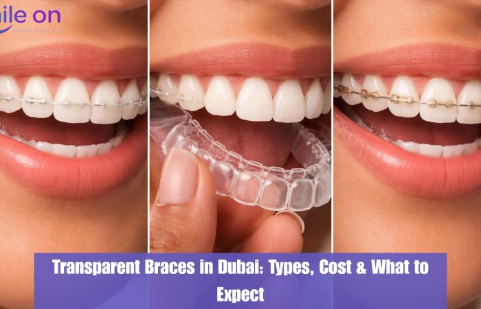 Transparent Braces in Dubai: Types, How They Work, and What to Expect