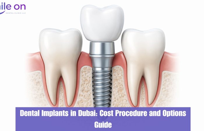Dental Implants in Dubai: Costs, Procedure & How to Choose the Right Clinic