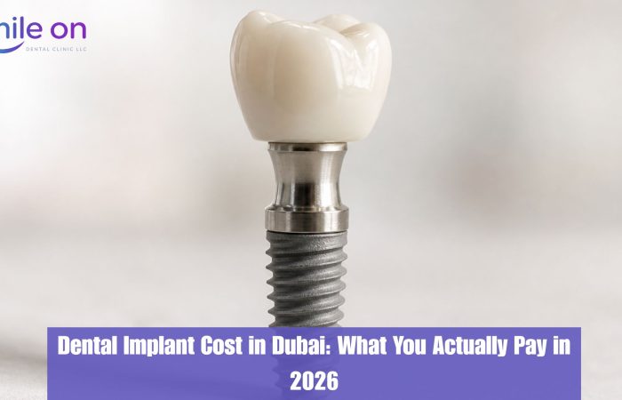 Dental implant components — post, abutment, and crown — used at Smile On Dental Clinic Dubai