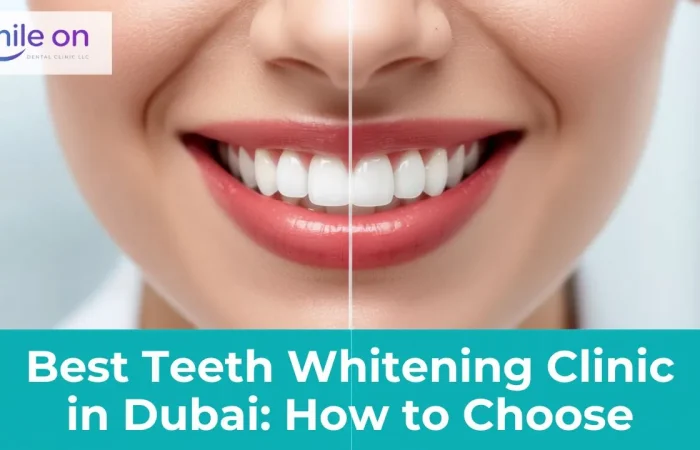 Best Teeth Whitening Clinic in Dubai: How to Choose — Smile On Dental Clinic