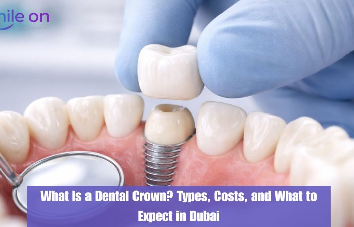 What Is a Dental Crown? Types, Costs, and What to Expect in Dubai