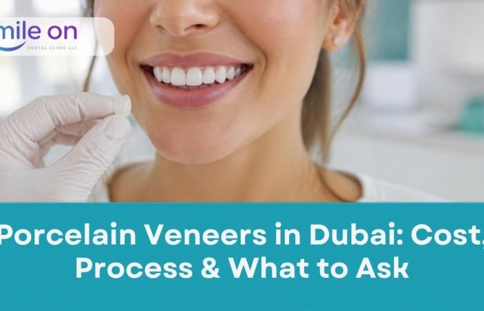 Porcelain Veneers in Dubai: Cost, Process and What to Ask, Smile On Dental Clinic