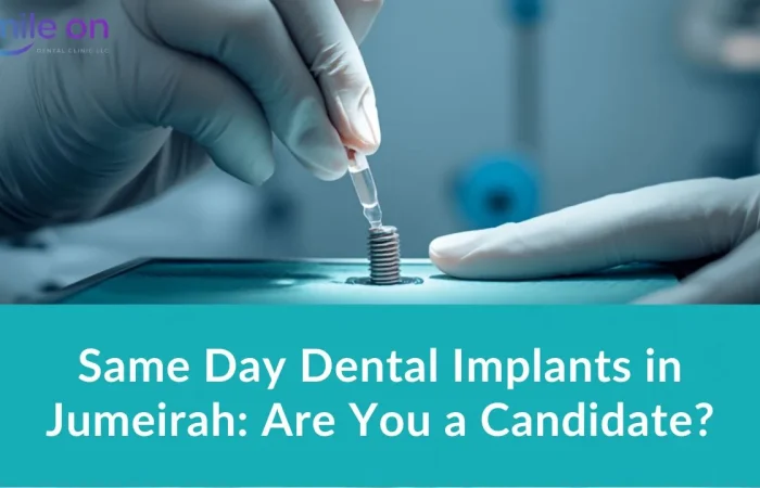 Same Day Dental Implants in Jumeirah: Are You a Candidate? — Smile On Dental Clinic